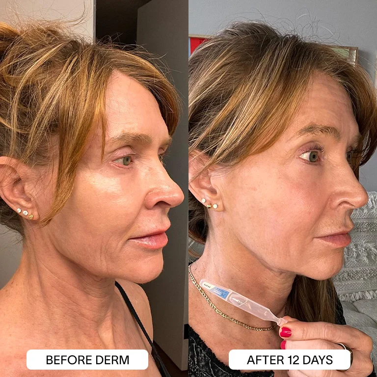 Derm™ 3% Hyaluronic Acid - Cyber Monday Sale - Image 15