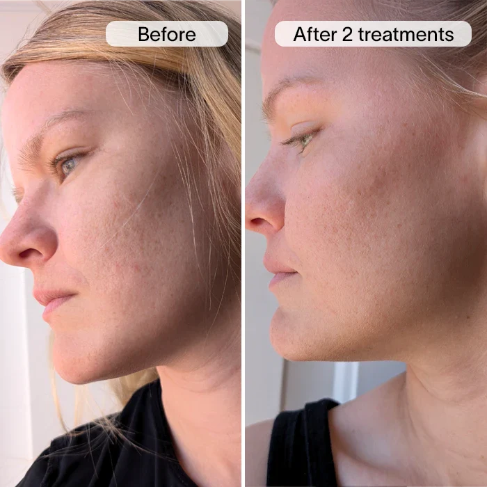 Derm™ PDRN Micro Infusion System - Image 15