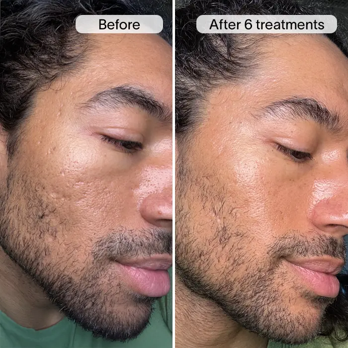 Derm™ PDRN Micro Infusion System - Image 4
