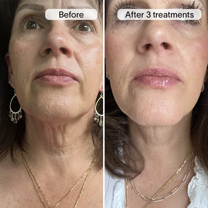 Derm™ PDRN Micro Infusion System - Image 13