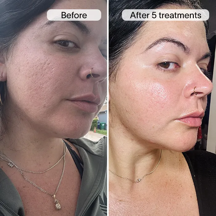 Derm™ PDRN Micro Infusion System - Image 6